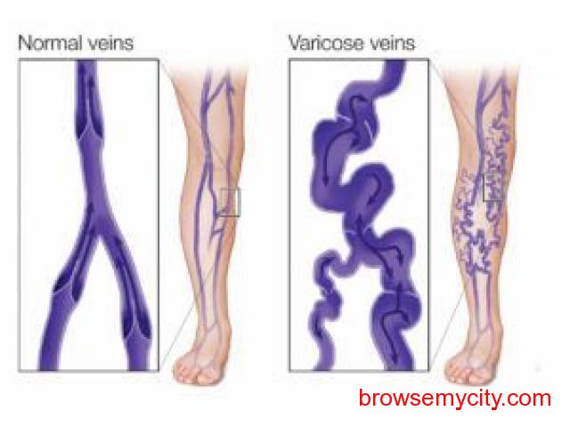 Are you suffering from Varicose Veins problem? - 120914