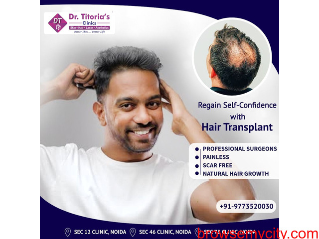 Expert Hair Loss Solution At The Best Hair Transplant Cost In Noida - 200246