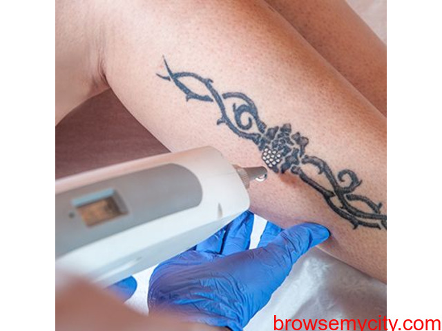 Top Tattoo Removal in Kothur Kurnool  Best Permanent Tattoo Removal   Justdial