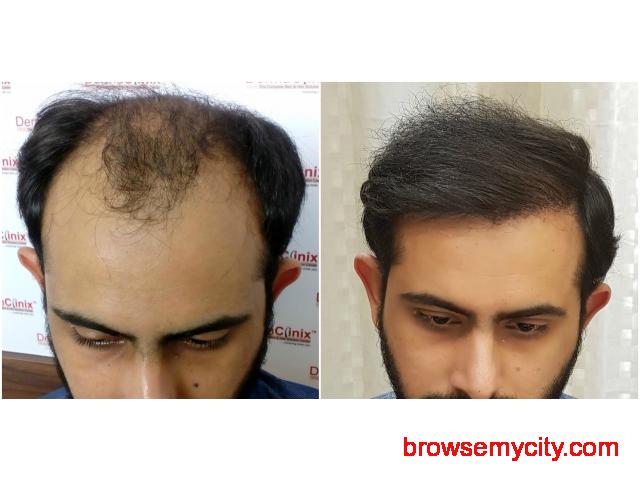Hair Transplant Before After - 25988