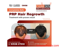PRP hair Treatment in hyderabad