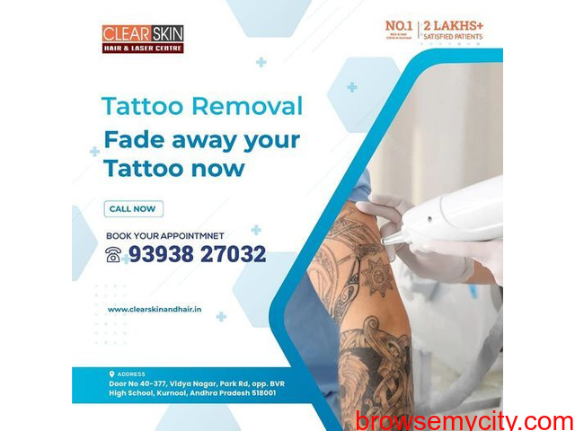 advance tattoo removal treatment in kurnool - 1/1