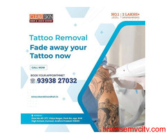 advance tattoo removal treatment in kurnool