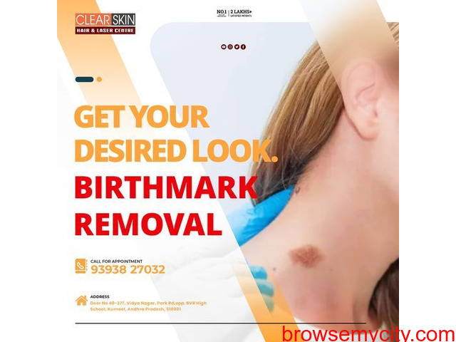 Laser Treatment For Birthmark Removal In India - 1/1