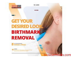 Laser Treatment For Birthmark Removal In India