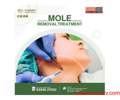 best mole removal treatment in kurnool