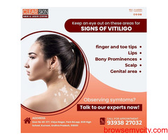Best Vitiligo Treatment In Kurnool || Laser Treatment || Skin Care  || Painfree || Clearskin and Hai