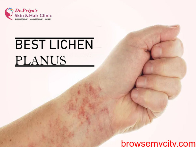 Best Lichen Planus Treatment In Marathahalli Bangalore 320423 0219