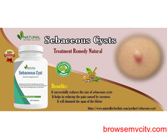 Home Removal of Sebaceous Cyst