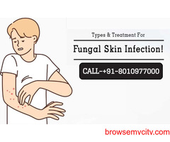 Best fungal infection doctor in Delhi Call 8010977000