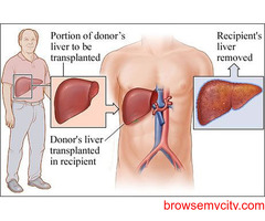 Liver Transplant Cost In India