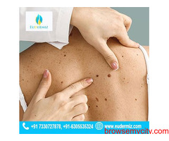 Safe and Effective Mole Removal Treatment in Hyderabad