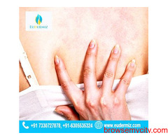 Expert Urticaria Treatment Services in Hyderabad
