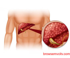 Liver Tumour treatment cost in India