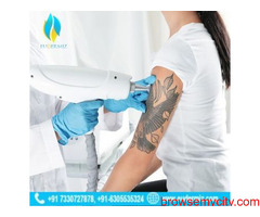 Advanced Tattoo Removal Treatment at Eudermiz Clinic