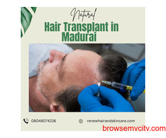 Renew Plus Hair Transplant in Madurai – Get Natural Results