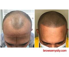 Scalp Micropigmentation Best Solution for Baldness