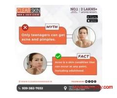 best vbeam laser treatment in india