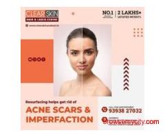 PRP hair Treatment in india