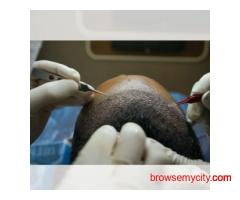 FUE Hair Transplant in Lucknow – Natural & Permanent Results