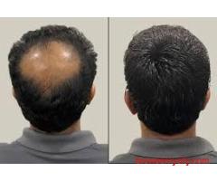 Natural-Looking Hair Patch in Jaipur