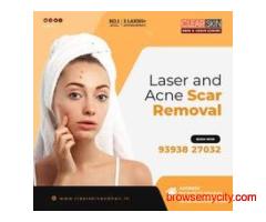 best Vitiligo Treatments in india