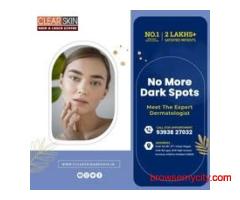 best pulsed dye laser treatment in india