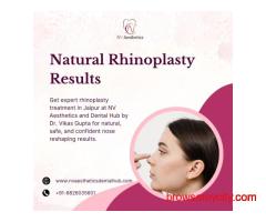 Natural Rhinoplasty Results