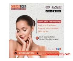 Stretch Marks  Laser  Treatment in India