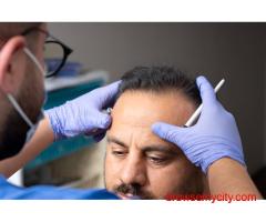 Say Hello to a Fuller You – Best Hair Transplant in Lucknow