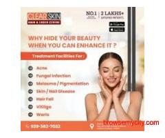 Laser Treatment For Birthmark Removal In India