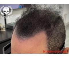 Affordable Scalp Micropigmentation Cost in Scotland & London – Skulltec