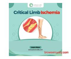 Symptoms of Critical Limb Ischemia | Advancells