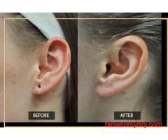 Earlobe Treatment in Delhi | Resplendent Cosmetics