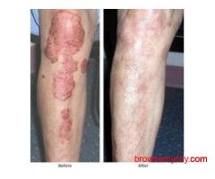Arogyam Pure Herbs Kit For Psoriasis