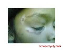 Arogyam Pure Herbs Kit For Vitiligo