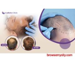 Best Hair Transplant Treatment in Surat - Callisto Clinic