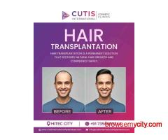 How Safe Is Hair Transplantation for Men and Women in Hyderabad?