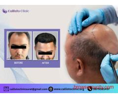 Get Long-Lasting Results with Best Hair Transplant in Surat - Callisto Clinic