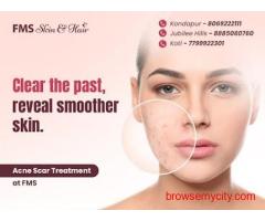 Best Acne Scar Treatment in Hyderabad - FMS Skin & Hair