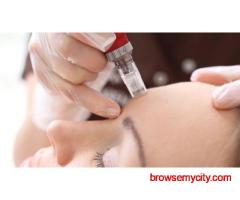MNRF Treatment in Jubilee Hills - FMS Skin & Hair