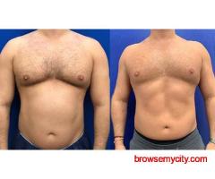 Fat Freezing Treatment: The Non-Surgical Solution for Fat Reduction