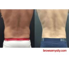 Fat Freezing Treatment: The Non-Surgical Solution for Fat Reduction