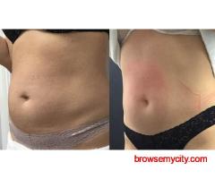 Fat Freezing Treatment: The Non-Surgical Solution for Fat Reduction