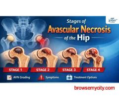 Stages of Avascular Necrosis Hip – Symptoms & Treatment
