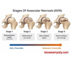 Stages of Avascular Necrosis Hip – Symptoms & Treatment