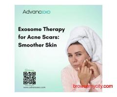 Exosome Therapy for Acne Scars: Smoother Skin