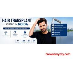 Best Hair Transplant Clinic in Noida for Natural & Permanent Hair Regrowth