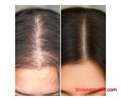 Advanced Hair Loss Treatment in Delhi for Men & Women | AAYNA Clinic