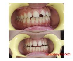 Teeth Whitening Clinic in Dwarka Sector 18